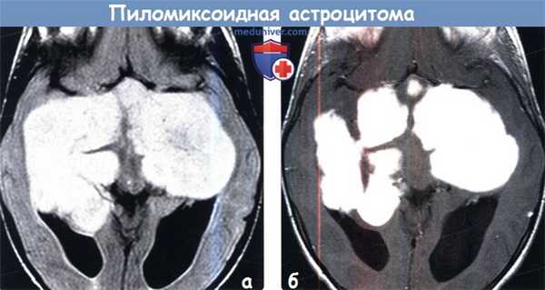 Пилоцитарная астроцитома. Астроцитома ствола мрт. Пилоцитарная астроцитома мрт. Пилоцитарная астроцитома лобной доли.