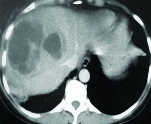 Абсцесс печени кт картина