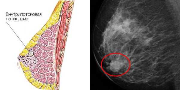 Папиллома молочной железы. Внутрипротоковая папиллома. Папиллома железы внутрипротоковая. Внутрипротоковые папилломы молочной железы. Внутрипротоковая папиллома маммография.
