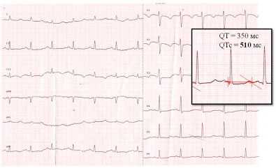 Удлиненное qt у ребенка. Удлиненный qt на ЭКГ. Синдром удлиненного интервала qt на ЭКГ. Интервал qt на ЭКГ. Синдром удлинения qt на ЭКГ.