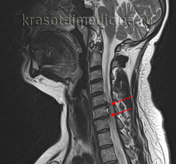Мрт шейного отдела позвонка
