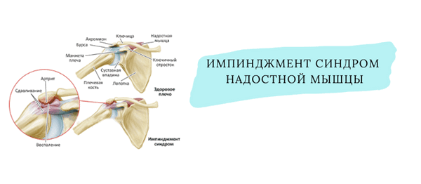 Импиджмент синдром плеча. Импиджмент синдром сухожилия надостной мышцы. Субакромиальный импинджмент синдром сухожилия надостной мышцы. Импинджмент синдром разрыв надостной мышцы. Синдром прижатия сухожилия надостной мышцы плечевого сустава.