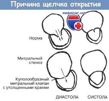 Шум на митральном клапане