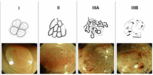 Тип по nice. JNET классификация эндоскопия. Sano классификация эндоскопия. Классификация в режиме NBI эндоскопия.