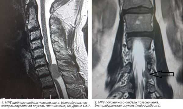 Костный отек позвоночника на мрт. Миелография опухоли спинного мозга. Кт миелография позвоночника. Миелография мрт. Интрамедуллярная опухоль спинного мозга шейного отдела позвоночника.