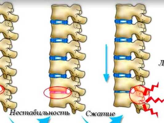 Люмбаго с ишиасом карта вызова скорой