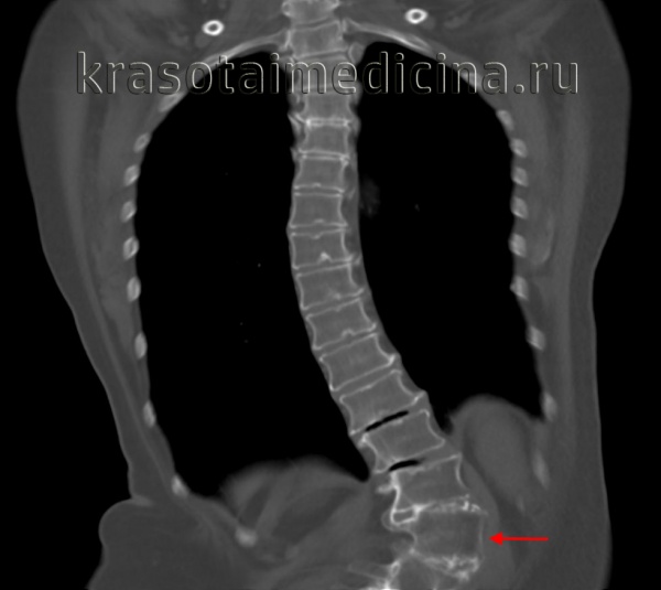 Сколиоз мкб. Кт позвоночника сколиоз. Кт позвоночника искривление поясничного отдела.