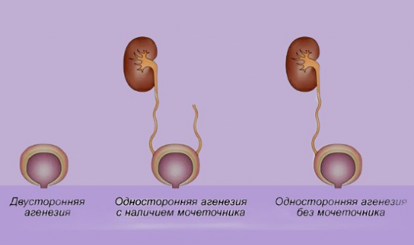 Агенезия венозного. Нефрогенная аденома мочевого пузыря. Агенезия яичка это в медицине.