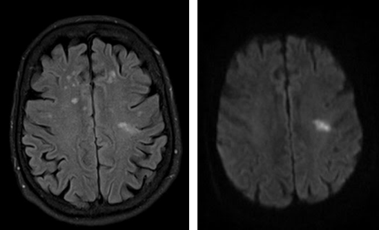 Единичный очаг в левой лобной доле. ОНМК по ишемическому типу мрт. Повышение сигнала от сосуда на мрт. МР картина единичных очаговых изменений вещества мозга. Симметричные очаговые изменения головного мозга сосудистого генеза.