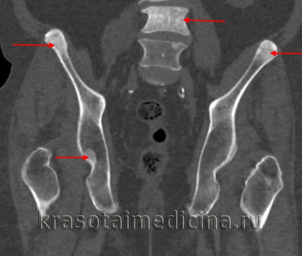 Метастазы в седалищной кости симптомы и признаки с фото