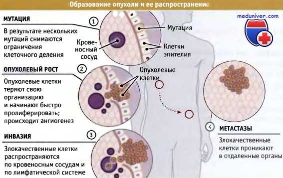 Как образуется рак. Раковые опухолевые клетки. Этапы образования раковых клеток. Раковые клетки мутировавшие.