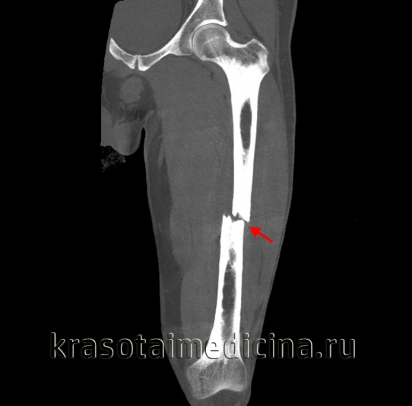 Перелом треть бедра. Перелом диафиза бедренной кости рентген. Перелом средней трети диафиза бедренной кости. Перелом тела диафиза бедренной кости. Перелом диафиза бедра со смещением.