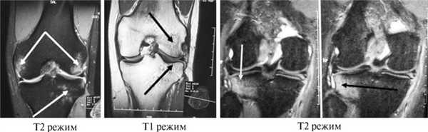 Т1 и т2 изображения мрт