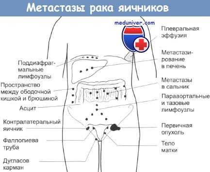 Удалить яичники при раке