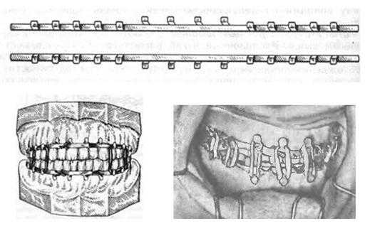 При переломе челюсти шинирование схема