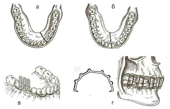 При переломе челюсти шинирование схема
