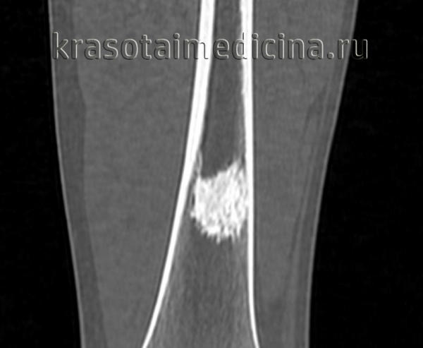 Энхондрома бедренной кости что это такое лечение фото