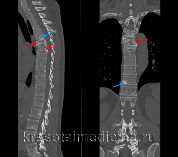 Патологический перелом. Патологический перелом позвоночника the3. Патологический компрессионный перелом тела l4-позвонка. Патологический перелом позвонка l2. Патологический перелом th6 позвонка.