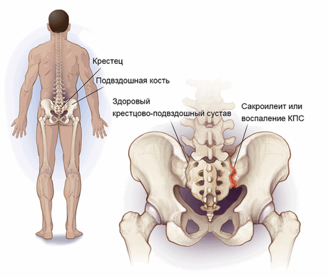 Крестцово подвздошные сочленения фото