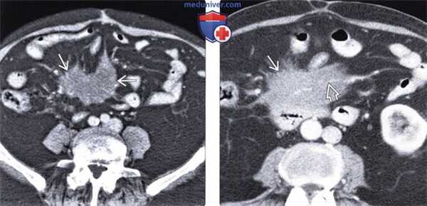 Кт картина мезентериального панникулита