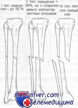 Перелом большеберцовой и малоберцовой кости. Перелом диафиза малоберцовой кости. Перелом диафиза большеберцовой кости классификация. Изолированные переломы диафиза малоберцовой кости лечение.