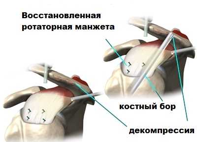 После артроскопии плеча