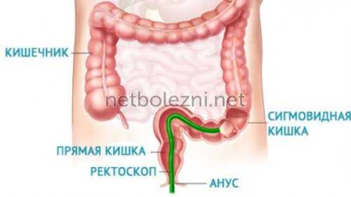 Ректоскопия кишечника