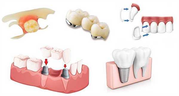 Виды несъемных зубных протезов