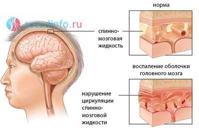 Киста в голове что это такое. Киста оболочек головного мозга. Киста головного мозга симптомы.