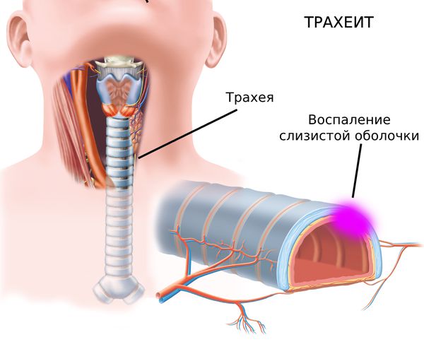 Трахеит где находится фото