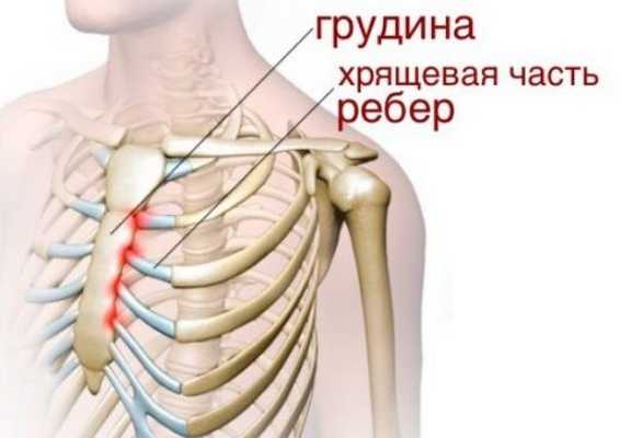 Титце синдром у детей фото