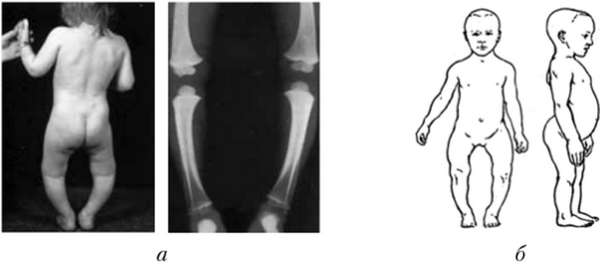 Рахит костей у детей. Гипофосфатемический рахит. Хондродистрофия, рахит. Фосфоропенический рахит.