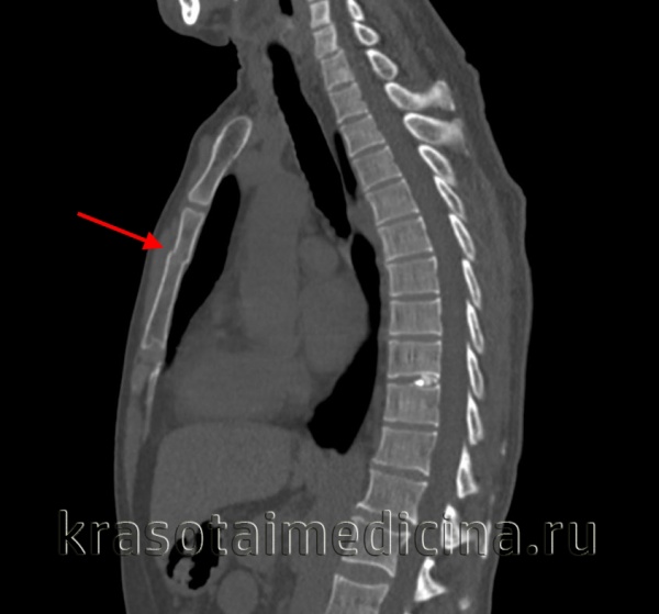 Перелом грудины. Перелом грудины рентгенограмма. Перелом рукоятки грудины рентген. Перелом тела грудины на кт.