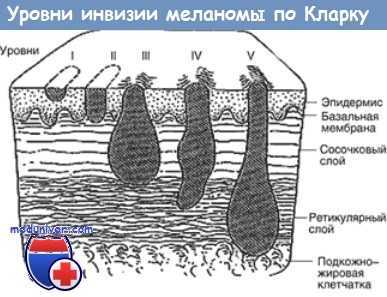 Меланома толщина по бреслоу. 2 Уровень инвазии меланомы по Кларку. 3 Уровень инвазии по Кларку меланома. Узловая меланома 4 уровень инвазии по Кларку. Классификация по Кларку.