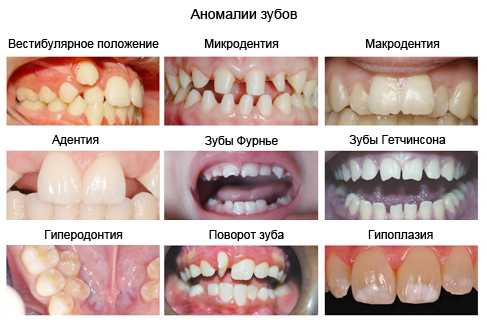 Супраокклюзия и инфраокклюзия. Мезиальное и дистальное положение зуба.