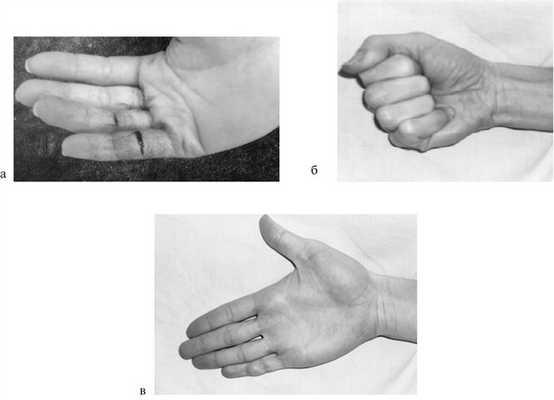 Разработать пальцы после. Операция на сухожилие на руке. Операция на сухожилие пальца. Операция на сухожилие мизинца. Разрыв сухожилия пальца.
