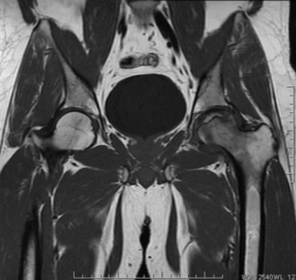 Что покажет мрт тазобедренного сустава у женщин. Мрт тазобедренного сустава норма. Импиджмент тазобедренного сустава на мрт. Мышцы тазобедренного сустава мрт. Снимки мрт тазобедренного сустава.