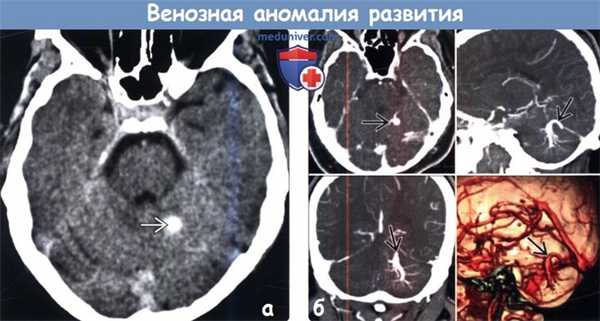 В серошкальном изображении гиперденсный участок