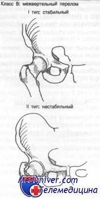 межвертельный перелом бедра