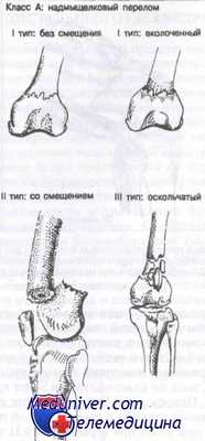 перелом дистального отдела бедра