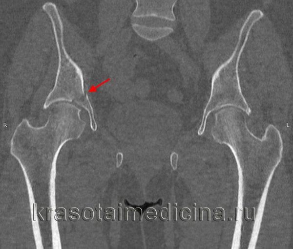 КТ таза. Перелом вертлужной впадины справа со смещением отломков.