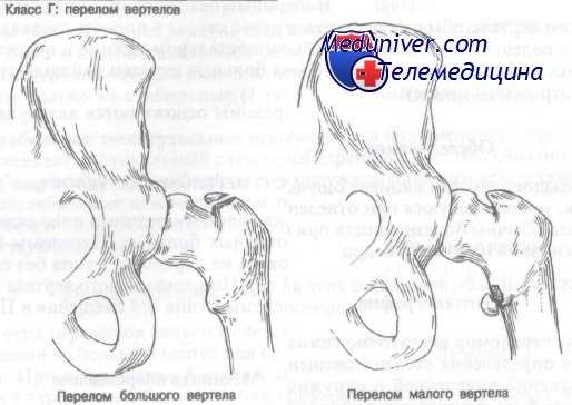 перелом вертела бедра