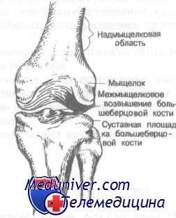 Межмыщелковое возвышение большеберцовой кости. Межмыщелковое возвышение коленного сустава. Перелом надмыщелка бедра. Надмыщелковый перелом бедренной кости. Надмыщелковая область бедренной кости.