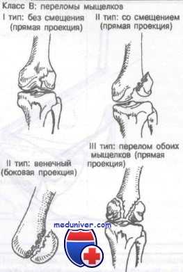 перелом дистального отдела бедра