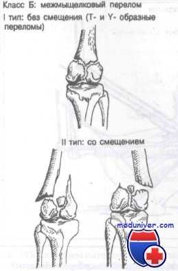 Мыщелок бедренной кости перелом. Переломы мыщелков бедренной кости классификация. Переломы дистального отдела бедренной кости. Переломы мыщелков бедренной кости. Чрезмыщелковый перелом бедренной кости.