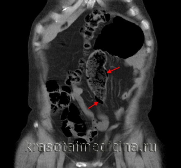 Что такое пневматоз кишечника. Пневматоз Толстого кишечника рентген. Пневматоз толстой кишки кт. Пневматоз ободочной кишки рентген. Пневматоз кишечника непроходимость.